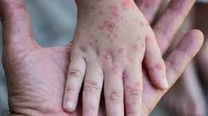 وزير الصحة التركي : تركيا تسجل أول إصابة بجدري القردة